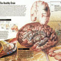 Healthy Brain/Unhealthy Brain