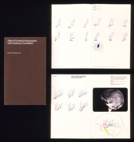 Atlas of Cerebral Angiography With Anatomic Correlation, 1974